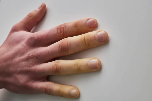 White fingers from the cold, poor blood circulation,close up — Stock Photo, Image