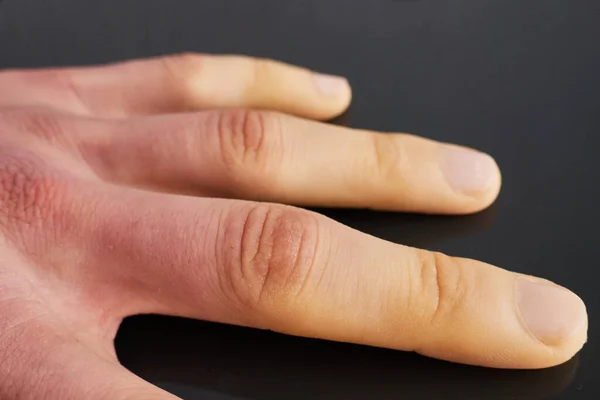 White fingers from the cold, poor blood circulation,close up — Stock Photo, Image