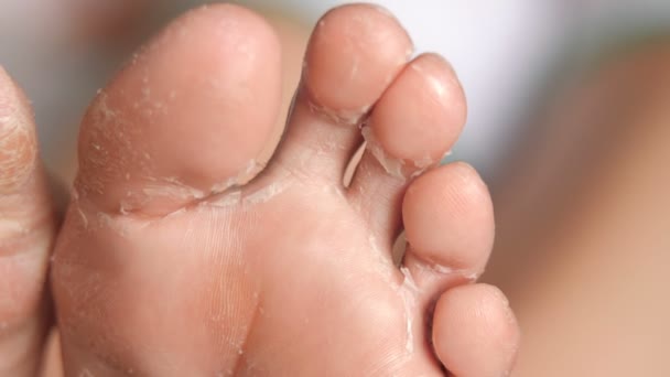 Pieds féminins lors d'une procédure d'épluchage acide. restauration de la peau. soins des pieds. santé et hygiène. — Video