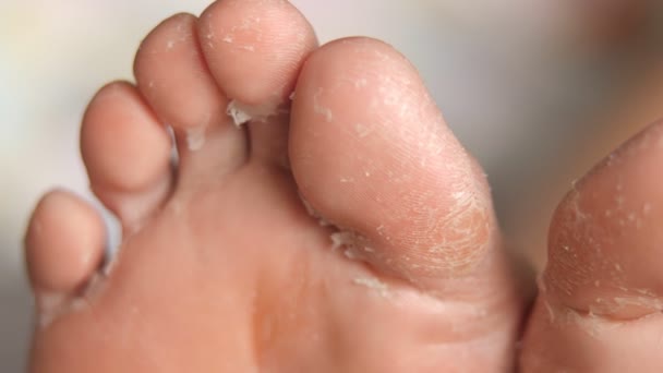 Pés femininos durante um procedimento de descascamento ático. renovação e regeneração da pele. restauração da pele. Cuidado com os pés. saúde e higiene. — Vídeo de Stock