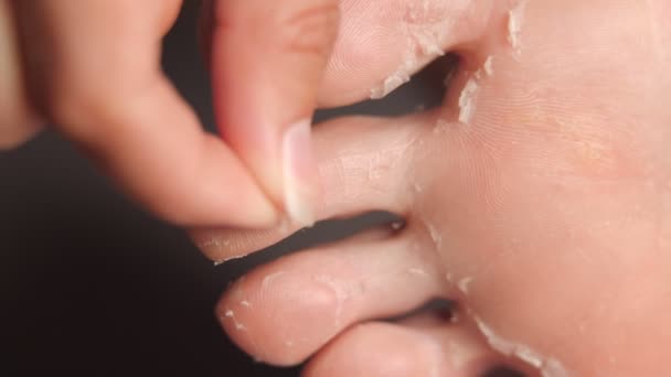 Pies femeninos durante un procedimiento de pelado de ácido.renovación y regeneración de la piel. restauración de la piel. cuidado de los pies. salud e higiene. Arranca pedazos de piel con las manos. — Vídeo de stock