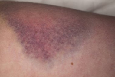 Yaralı kadın derisindeki çürüğe yakın çekim. Yaralı kadın bacağındaki çürüğe yakından bak. Cinsiyet şiddeti kavramı. Kan damarlarının bütünlüğü zarar görmüş, şiddetli bir darbe sonucu hematom oluşmuş.