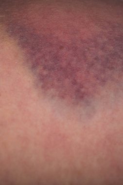 Yaralı kadın derisindeki çürüğe yakın çekim. Yaralı kadın bacağındaki çürüğe yakından bak. Cinsiyet şiddeti kavramı. Kan damarlarının bütünlüğü zarar görmüş, şiddetli bir darbe sonucu hematom oluşmuş.