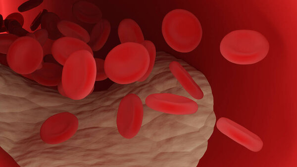 Atherosclerosis. Atheromatous plaques. Arteriosclerotic vascular disease. 3d illustration