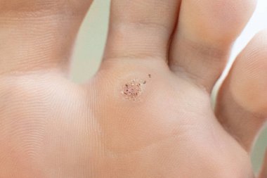 wart on a blunt close-up. Macro shot of human papilloma on the foot. clipart