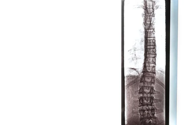 肺和胸部后部骨骼X光检查 以防脊柱侧弯和曲率 — 图库照片