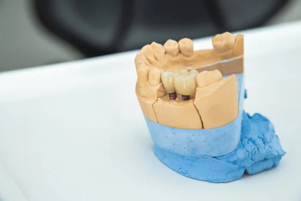Silikonların üzerine seramik taç takılmış yapay bir çene stolmatoloji ofisinde cerrahi bir camın üzerinde duruyor. Diş sağlığı ve tedavi kavramı