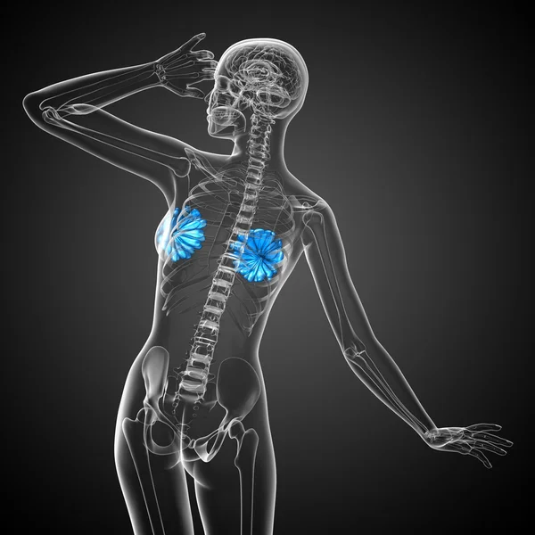 3d 渲染医学插图的人乳腺癌 — 图库照片