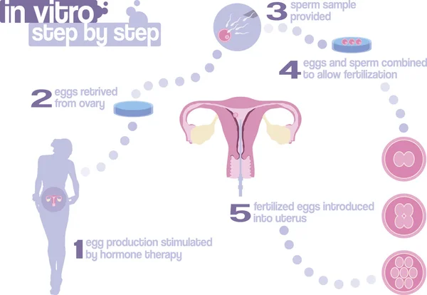 Оплодотворение in vitro шаг за шагом — стоковый вектор