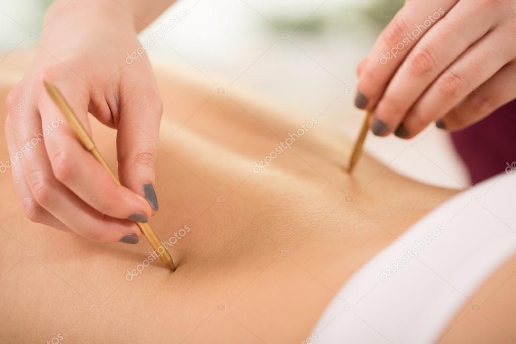 Woman during acupuncture session