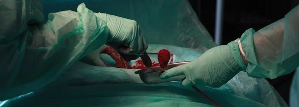 Cirurgião cortando um tumor — Fotografia de Stock
