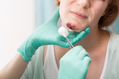 Hemşire tedavi yara yüzünde