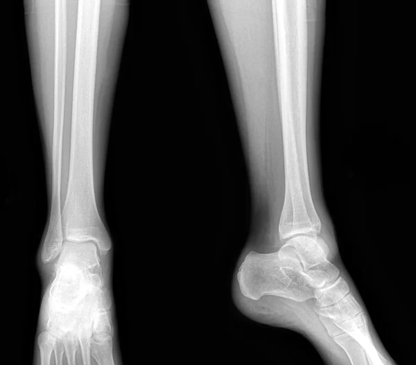 真正的 x-射线的健康低腿-前面和侧视图 图库照片