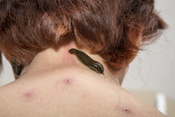 Behandling av människor av medicinska blodiglar. — Stockfoto