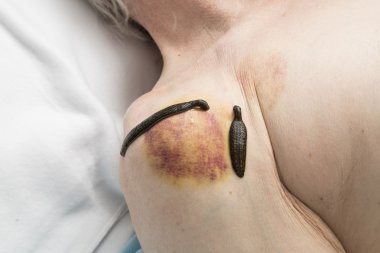 Tıbbi sülük insanlar ve akupunktur tedavisi.