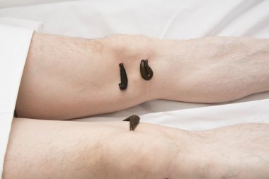 İnsanların tıbbi sülük tedavi.