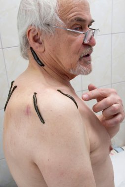 Sülükler omuz ve boyun alanı, arka alanda ile tedavi 