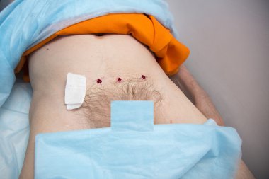 İnsanların tıbbi sülük tedavi.