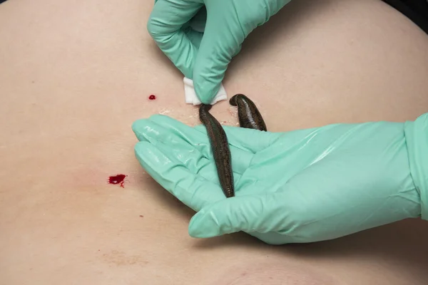 Tratamento de pessoas de sanguessugas médicas . — Fotografia de Stock