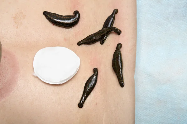 Treatment of people of medical leeches. — Stock Photo, Image