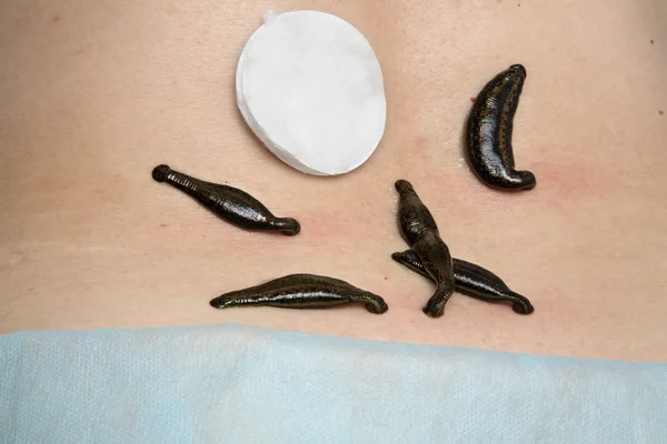 Treatment of people of medical leeches. — Stock Photo, Image