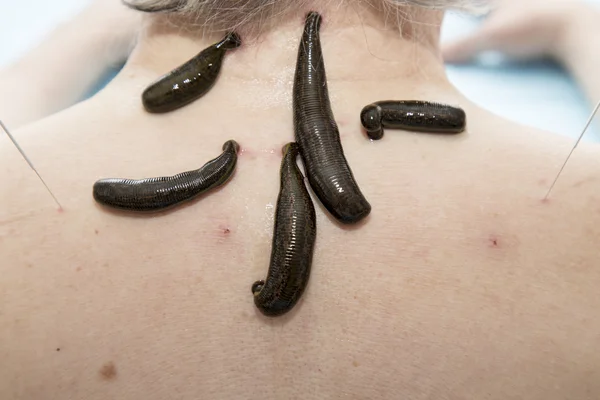 Treatment of people of medical leeches. — Stock Photo, Image