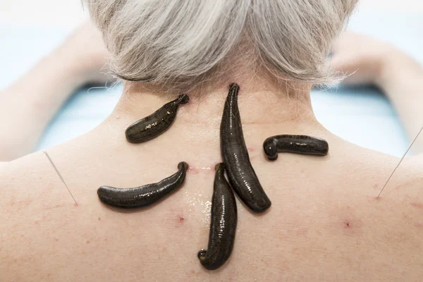 Tratamiento de las personas de sanguijuelas médicas . — Foto de Stock