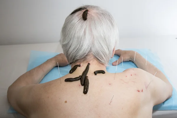 Treatment of people of medical leeches. — Stock Photo, Image