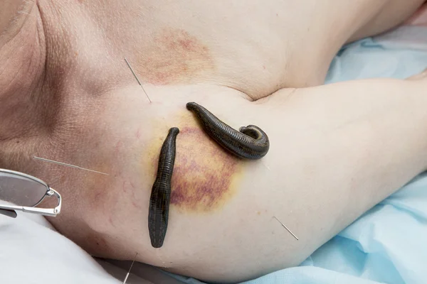 Treatment of medical leeches people and acupuncture.