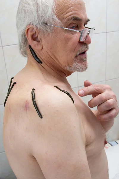 Treatment with leeches shoulder and neck area, back area in the — Stock Photo, Image