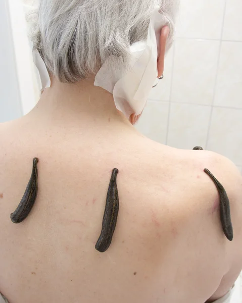 Treatment with leeches shoulder and neck area, back area in the — Stock Photo, Image