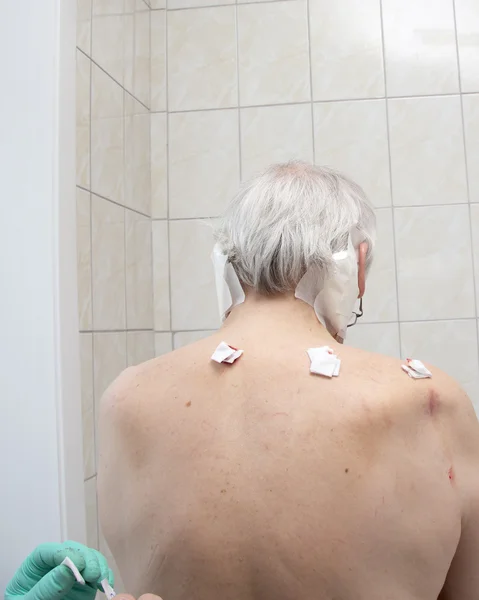 Treatment with leeches shoulder and neck area, back area in the — Stock Photo, Image