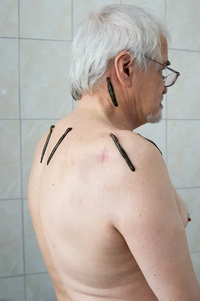 Treatment with leeches shoulder and neck area, back area in the — Stock Photo, Image