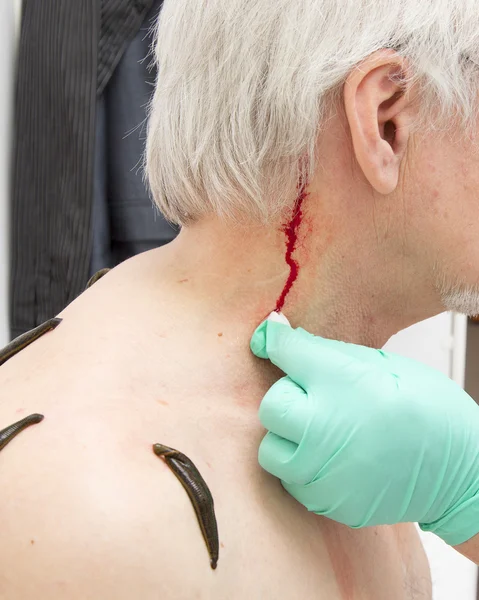Treatment with leeches shoulder and neck area, back area in the — Stock Photo, Image