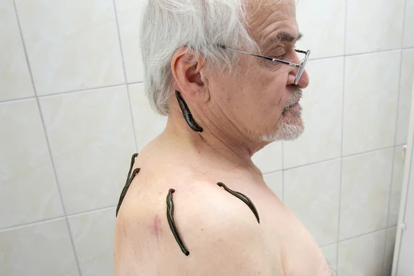 Лечение пиявками области плеч и шеи, области спины в — стоковое фото