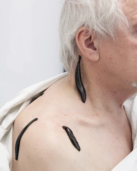 Treatment with leeches shoulder and neck area, back area in the — Stock Photo, Image