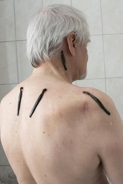 Treatment with leeches shoulder and neck area, back area in the — Stock Photo, Image