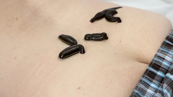 Treatment of people of medical leeches. — Stock Photo, Image