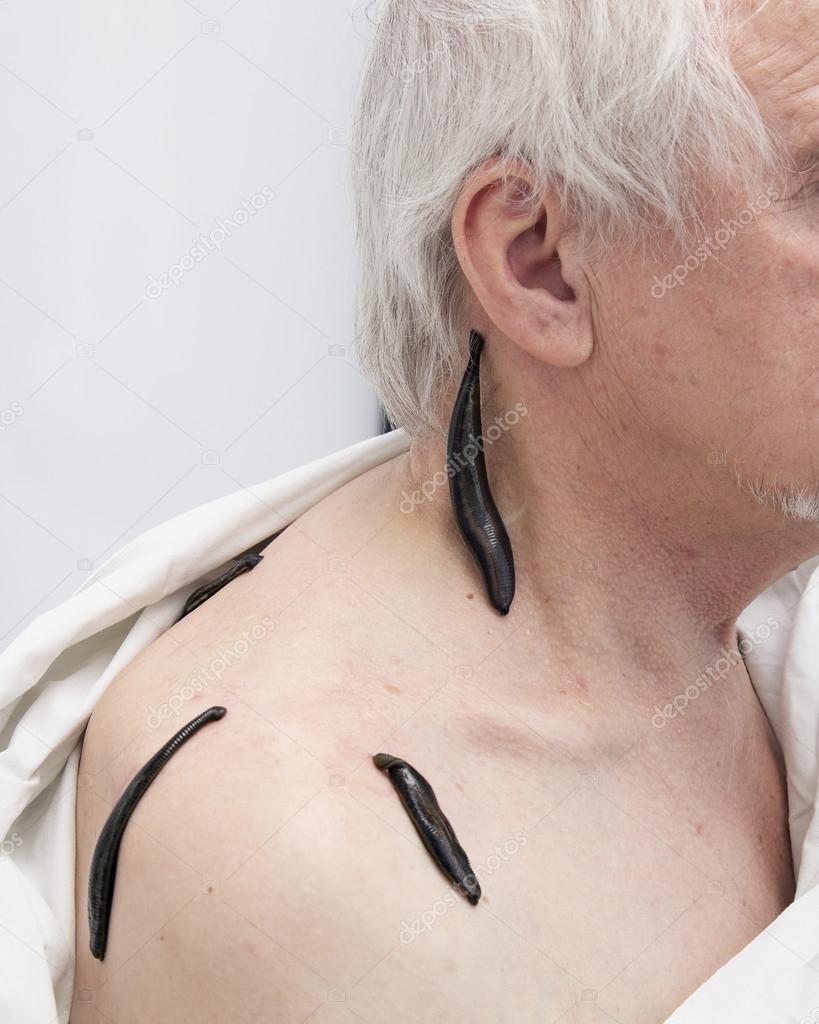 Treatment with leeches shoulder and neck area, back area in the 