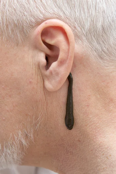 Leech therapy — Stock Photo, Image