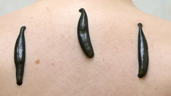 Leech therapie Stockfoto