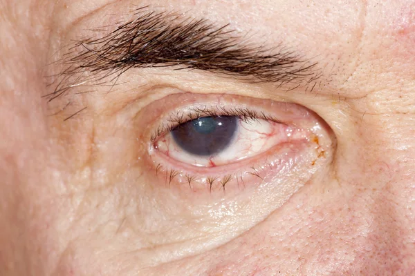 Маразматическая катаракта — стоковое фото