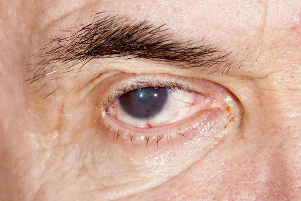 Senile cataract eye examination — Stock Photo, Image