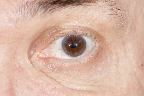 Senile cataract eye examination — Stock Photo, Image