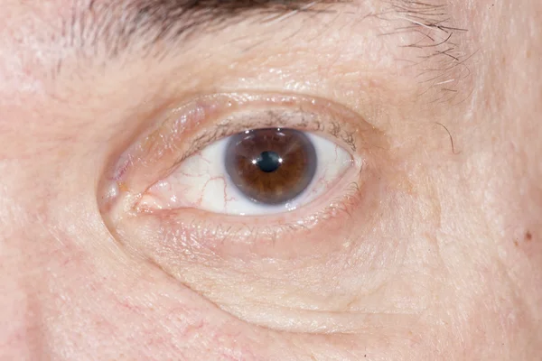 Senile cataract eye examination — Stock Photo, Image