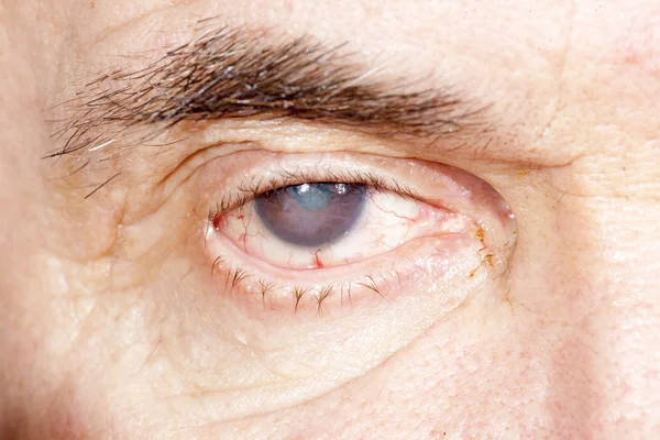 Senile cataract oog onderzoek — Stockfoto