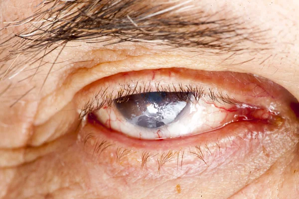 Exame ocular de catarata senil — Fotografia de Stock