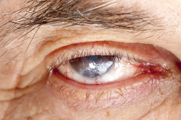 Дослідження катаракти сіна — стокове фото