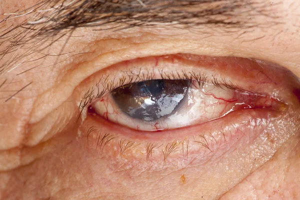 Senile cataract oog onderzoek — Stockfoto