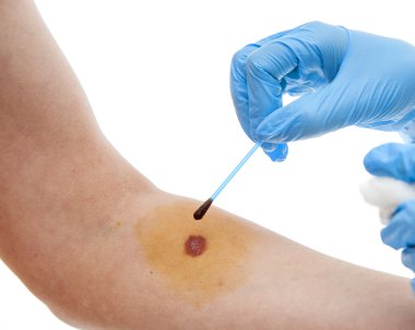 Nurse applying  iodine
